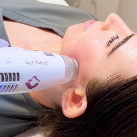 RF Microneedling